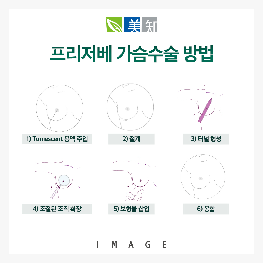 프리저베가슴성형