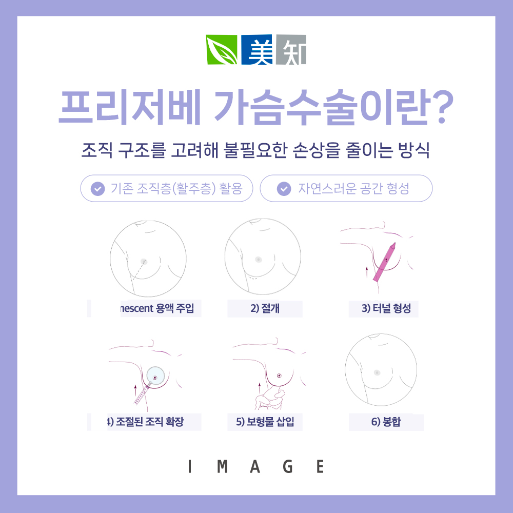 모티바프리저베 가슴수술이란?