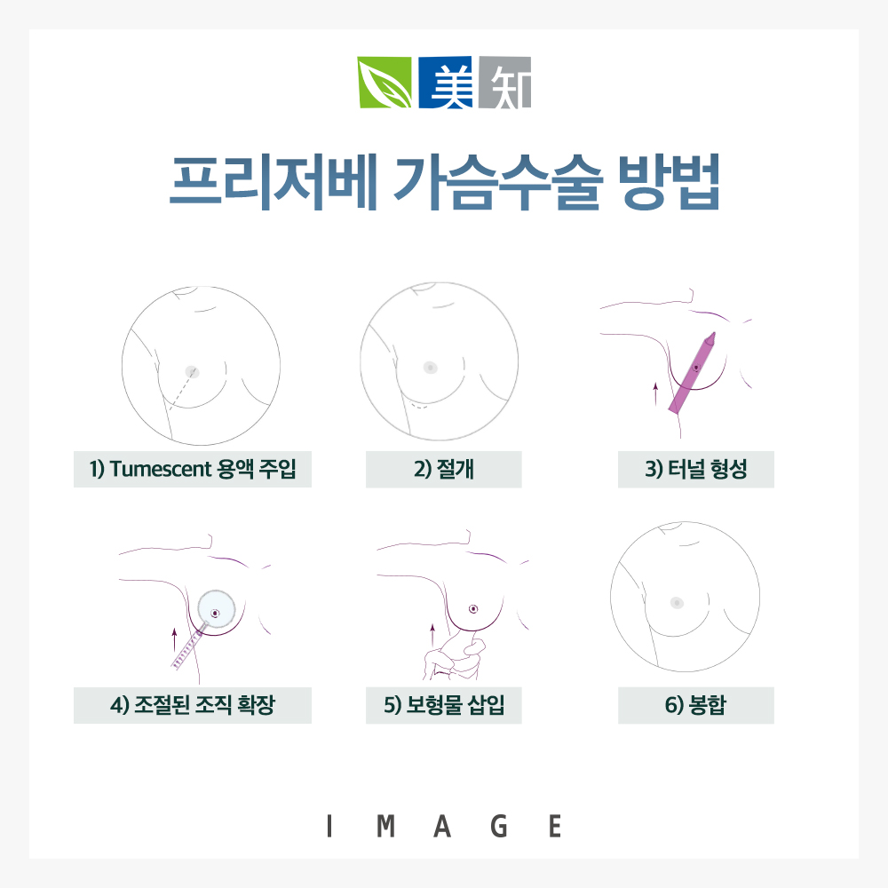프리저베가슴수술