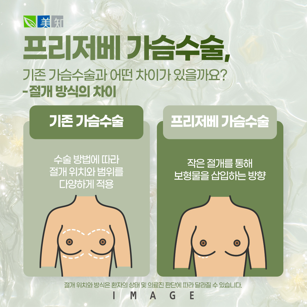 모티바프리저베 가슴수술 차이점