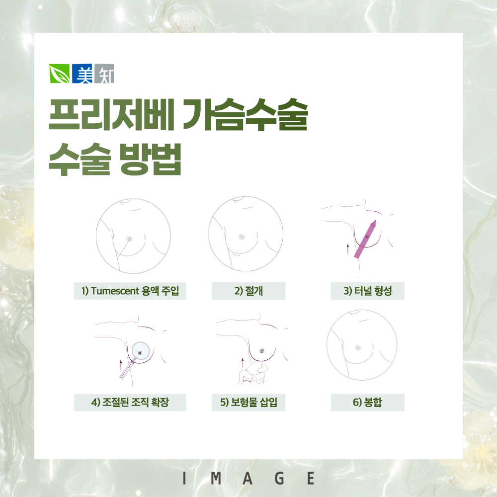 모티바프리저베 가슴수술 방법